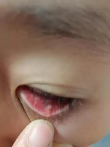 眼镜里面长出白点,下睫毛根部也有,是眼疮吗?可以用蒲地蓝吗