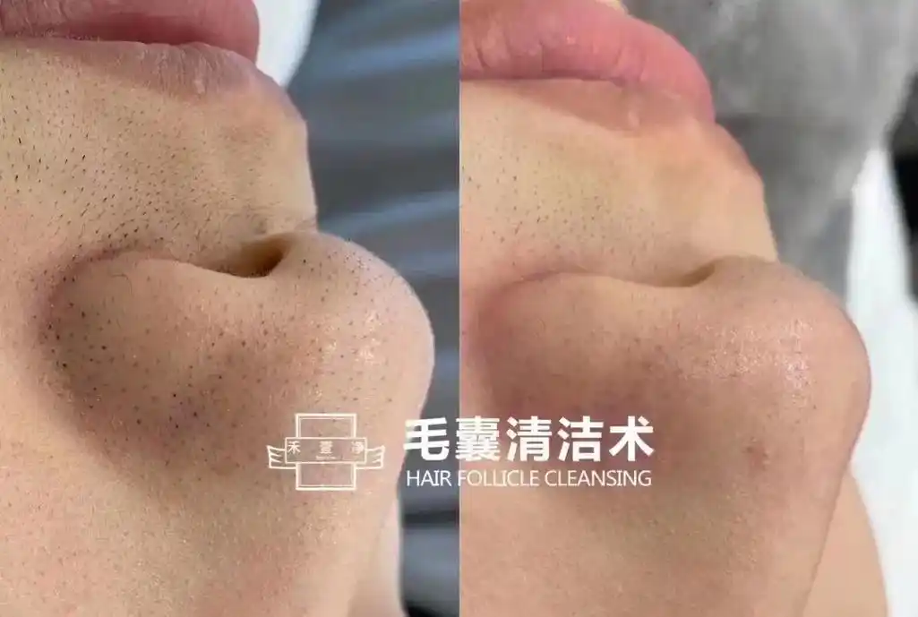 皮肤管理#毛囊清洁 #拒绝草莓鼻 - 抖音