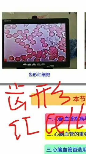 齿性红细胞  营养不良 肠功能下降 减肥人群 糖尿病患者 长期吃肉不