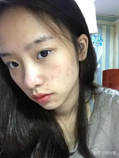 怎么看待五官漂亮但是皮肤差的女性?