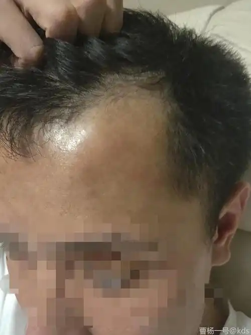 30岁,两额头发已经秃成这样,怎么办?
