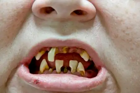 矢量插图.腐烂和破坏牙齿或蛀牙3d.