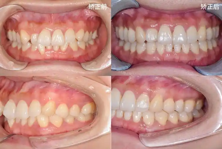 不拔牙改善突嘴乱牙,收获更好的自己