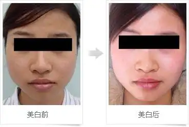 注射美白针前后对比图