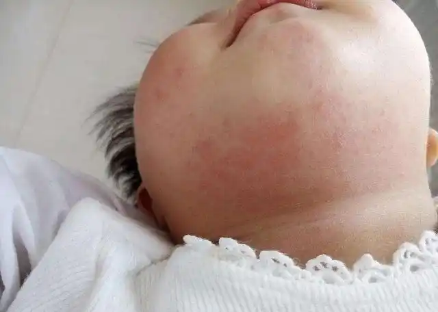 哪些宝宝不建议做过敏原检测