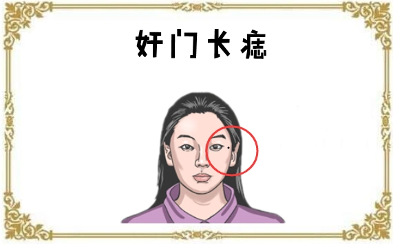 女人5颗"妨夫"痣,婚后拖丈夫后腿,对健康不利!