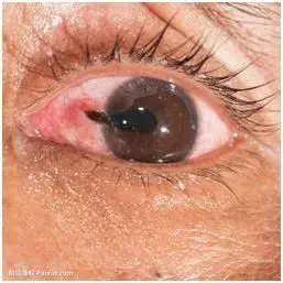 健康科普重视儿童眼外伤