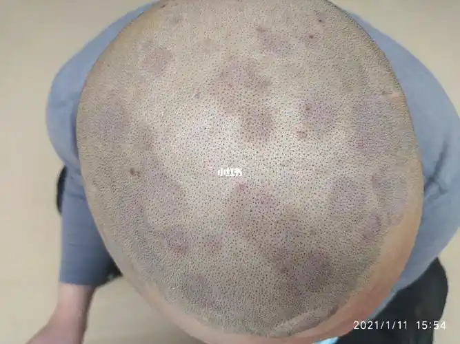 皮肤镜和免疫荧光染色检查来帮忙,最终结果是:头皮银屑病