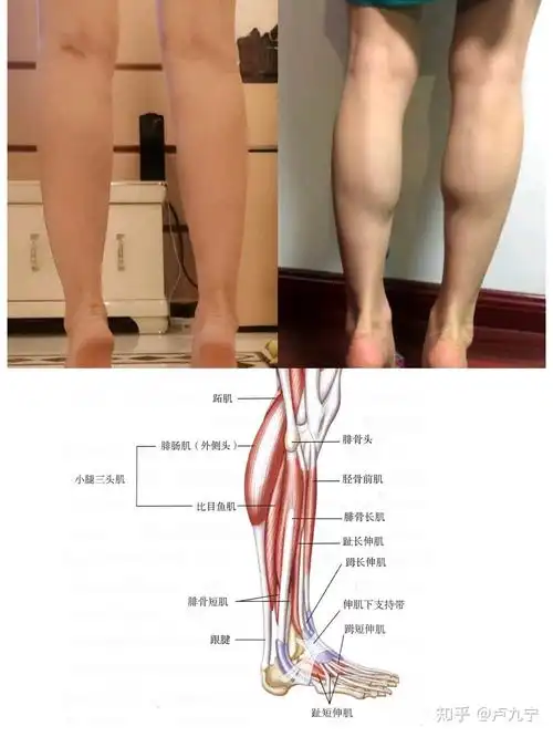 神经阻断瘦小腿小腿肌肉过于发达腿部线条视觉上会粗犷