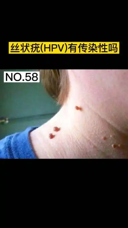丝状疣有传染性吗?术后需要注意什么呢?-度小视
