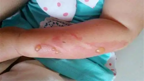 2岁宝宝被热水烫伤妈妈立即冷水冲洗遭医生训斥步骤错了