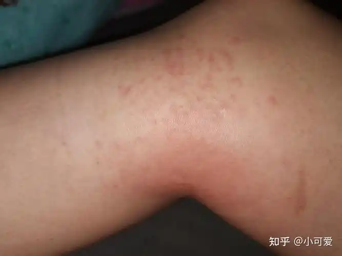 膏药过敏引发的过敏性皮炎治疗心酸历程(有图做好心里准备) - 知乎