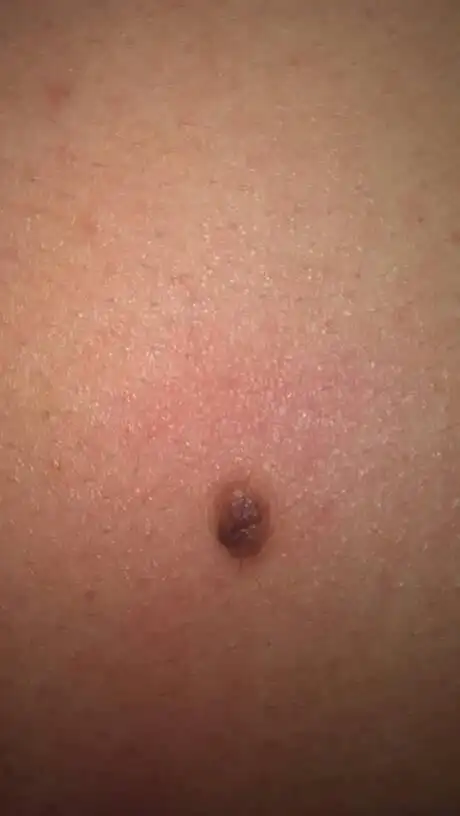 背上有个大痣,大约6到8mm,旁边还有个小的,大概有
