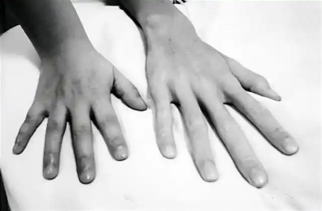 马凡综合征目前无法彻底治疗在治疗中要根据具体症状选择方法