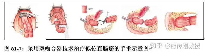结直肠癌手术为什么要用吻合器,吻合器有什么优势?