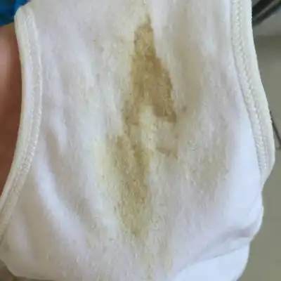 白带异常…怀孕38天,这正常么,需要扎孕酮针和止血针么