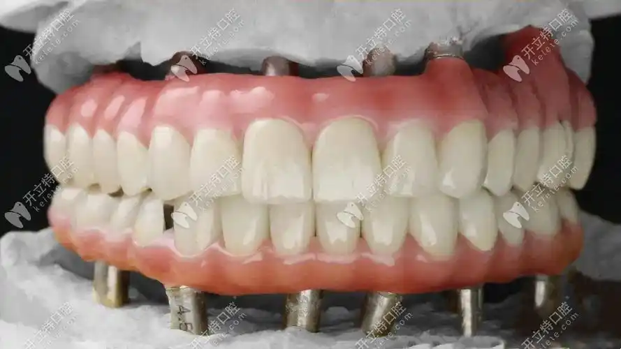 马龙桥支架是修复中安装在植体上,去和牙冠连接的一个桥架,而纯钛支架