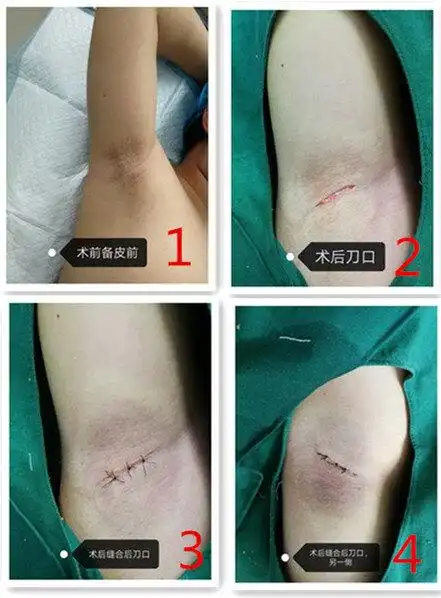 小切口微创治疗腋臭一例_腋臭_治疗方式_日常注意事项 - 好大夫在线