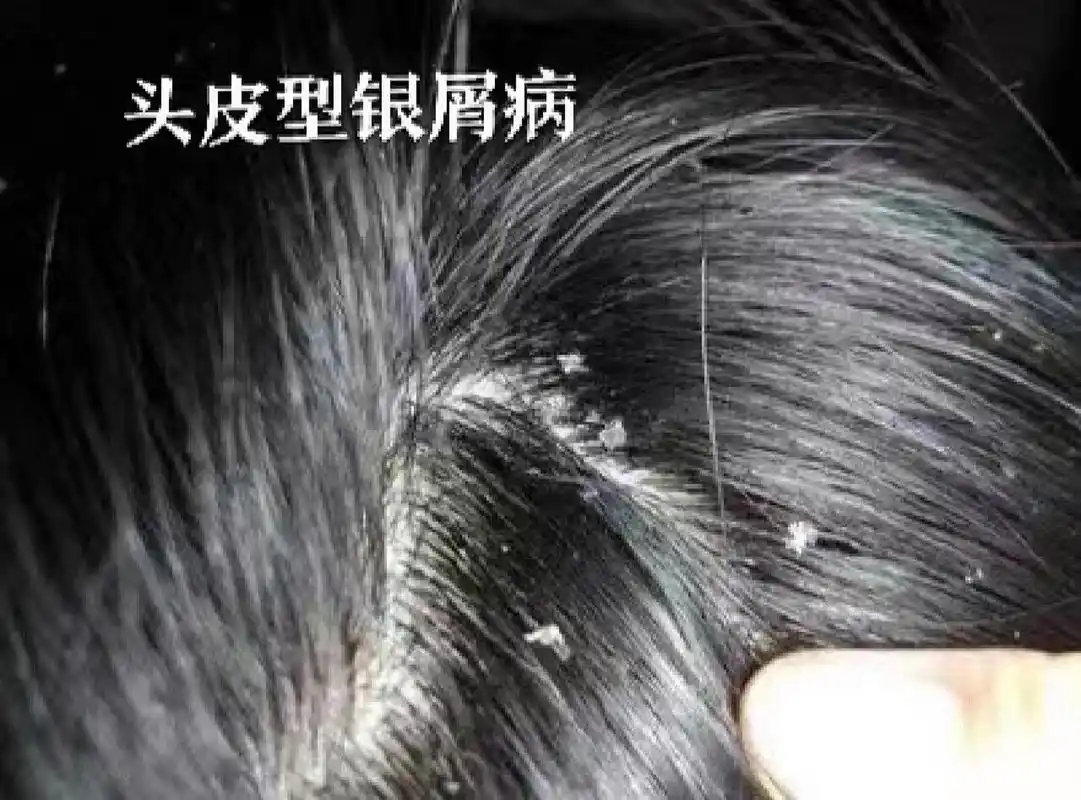 今日科普21566头皮型银屑病959595 98头皮型银屑病60