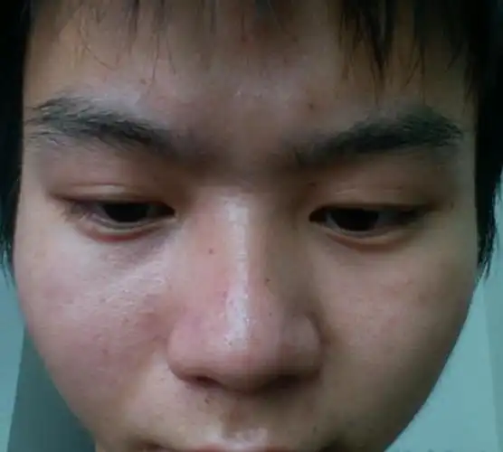 像这种皮肤问题要怎么解决,毛孔粗大,毛孔里面还有黄色的小颗粒油也