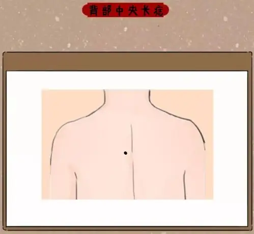 背部中央长痣