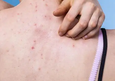 痤疮是一种常见的皮肤病,尤其是在青春期.