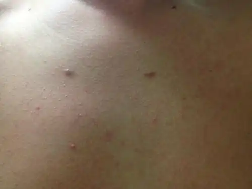 胸口长了一些小红点点长的是什么呀?