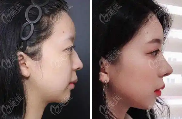 韩国vg百利酷整形鼻综合手术前后对比图