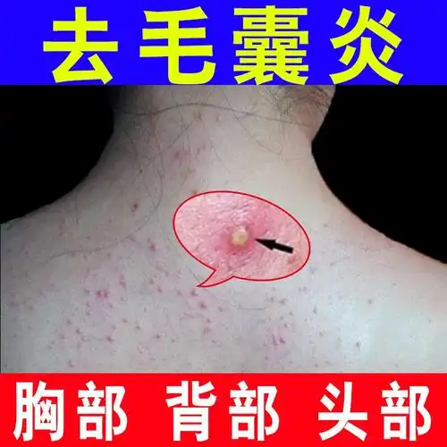 毛囊炎的药膏专用治疗胸前头皮脸部毛囊炎脓包痤疮膏祛痘皮炎神器