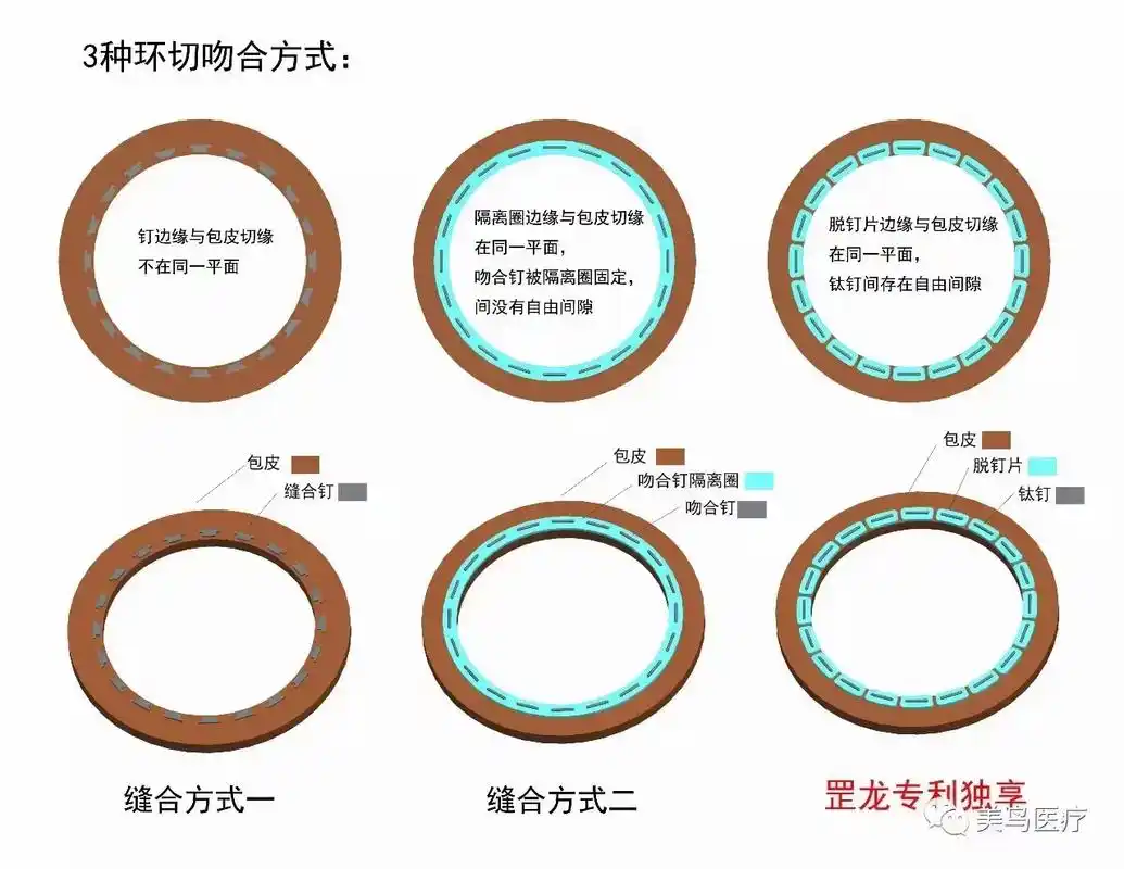 国内创新自脱钛钉包皮吻合器 - 抖音