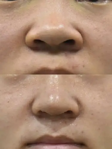 鼻翼缩小术