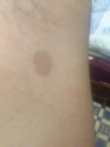 我这个是咖啡斑嘛,还是皮肤癌,不是胎记