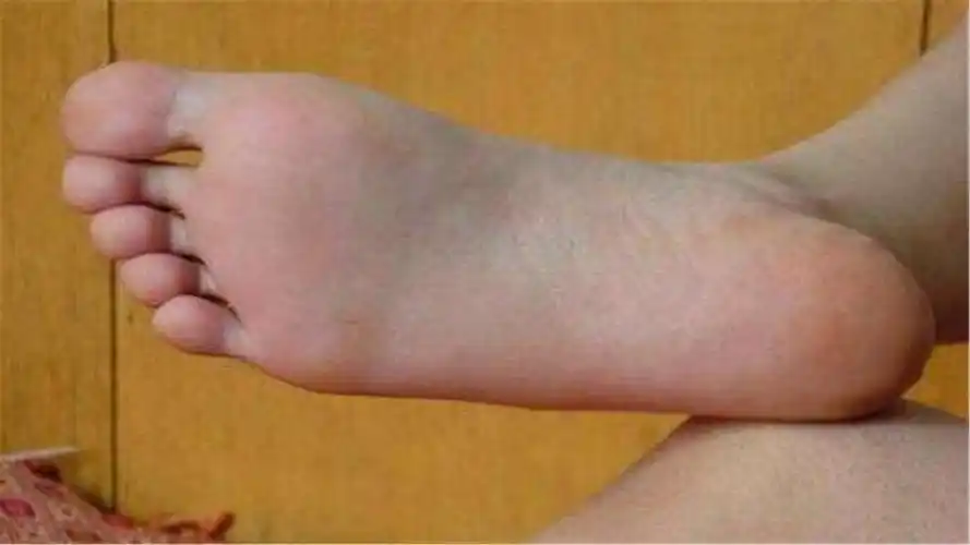 怎样解决脚部出汗问题?