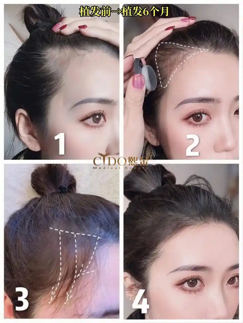 天生秃额角,发际线不好看怎 - 抖音