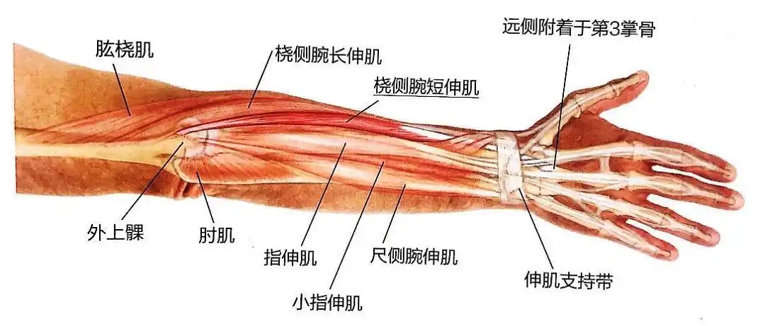 症状表现症状最明显的区域通常是腕伸肌(尤其是桡侧腕短伸肌)肌腱与骨