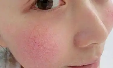 怎么修复角质层薄?你的角质层薄是否是因为这样?快来看要如何修复