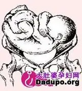 p>胎儿横卧于 a href="#" data-lemmaid="17007">子宫 /a>内约占 a