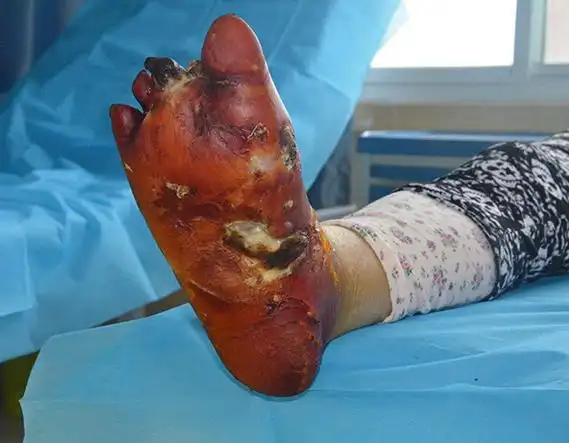 糖尿病足脚红肿,溃烂转入我院保肢治疗康复案例