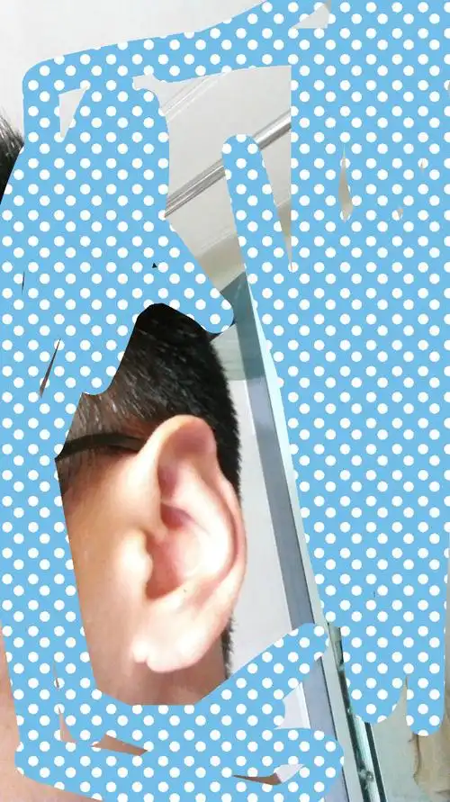 右耳朵耳廓软骨缺一块.不到1cm 0.7左右.问几个问题. 1.