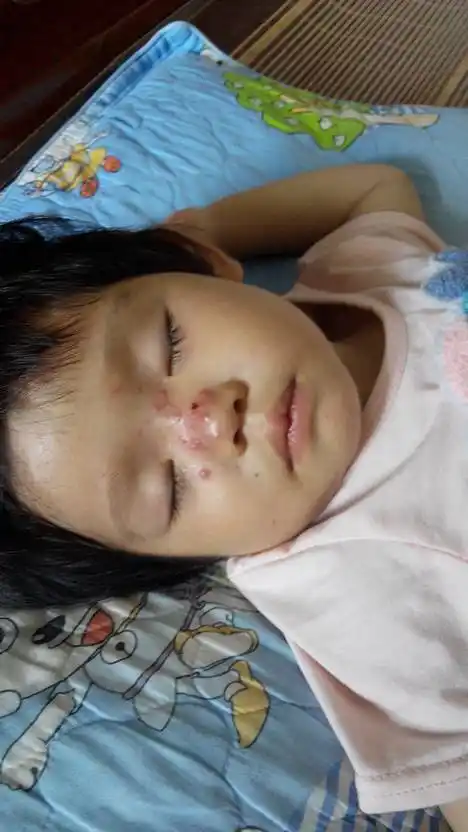 热毒有什么好办法?小孩鼻子上长很多热疹