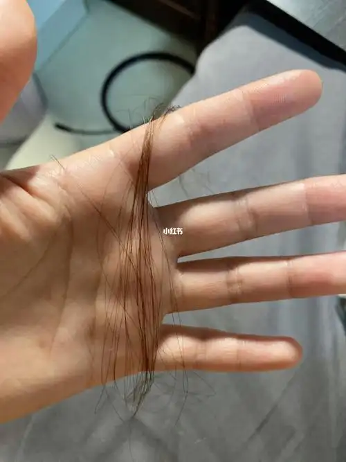 不要小看这一撮头发_脱发_维a_医疗健康_医疗健康其他