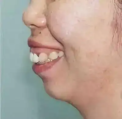 什么是"地包天"和"天包地"面相?无论男女,一生坎坷!