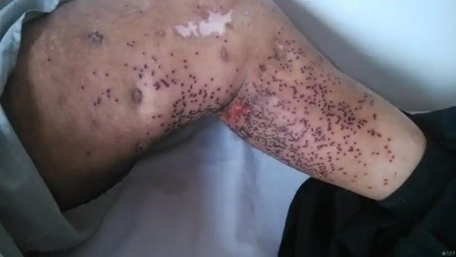 一老外腿上严重的皮肤病请教大家