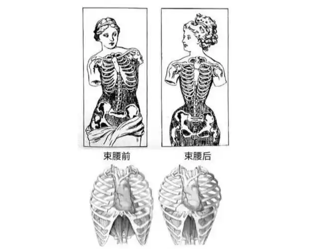 图片虽然有点夸张,但是束腰真的类似背背佳,懂运动康复的都知道,这类