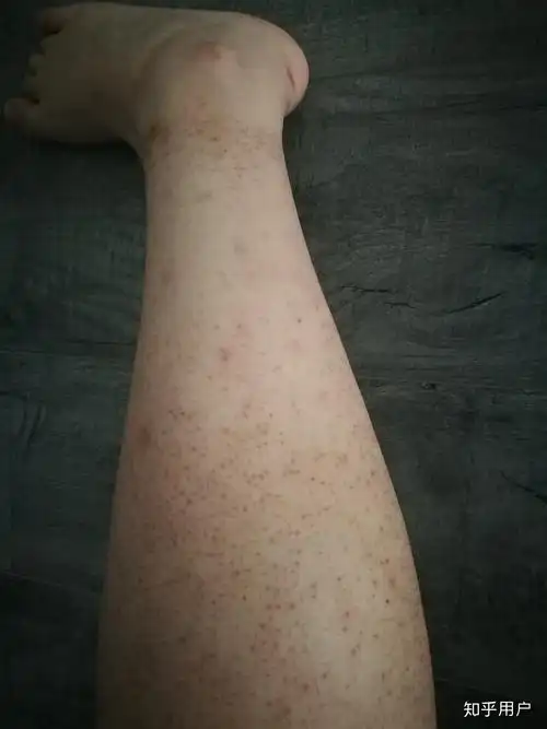 毛囊角质化鸡皮肤是否无法改善