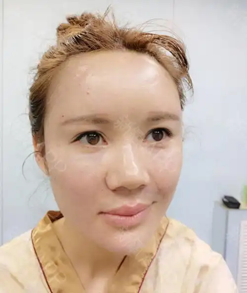 北京自体脂肪全脸填充好不好_效果图_氧气xt6d1自体脂肪全脸填充术后