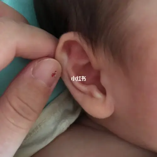 宝宝50多天了,前两天用手扒宝宝耳朵才发现他一只耳朵的内外耳廓的肉