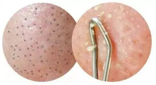 作为高要求的你,颜值是否都败在了痤疮痘痘(白头黑头粉刺丘疹)上(一)