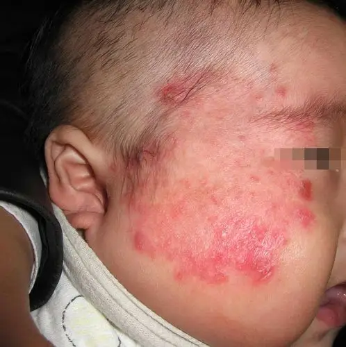 儿童体癣是怎样得来的_皮肤科_阿里康网