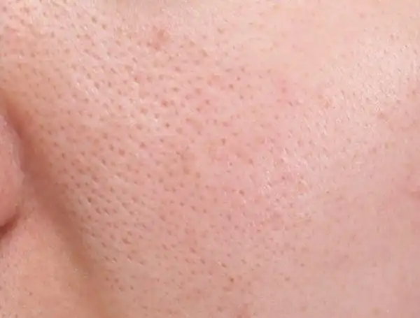 周期去角质保湿防晒;油光型:油脂分泌旺盛,形成脂栓,毛孔粗大